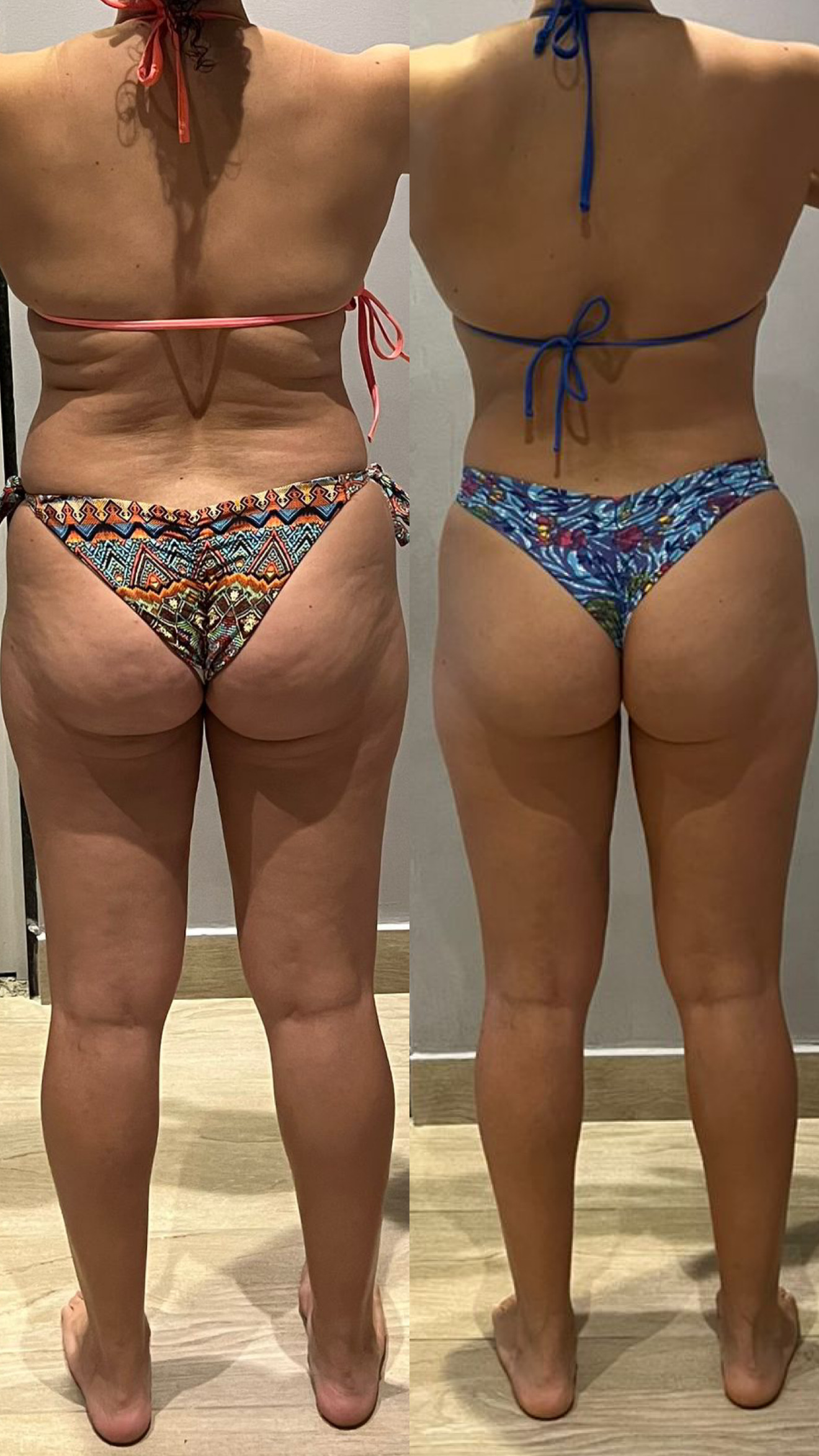 ANTES E DEPOIS 1